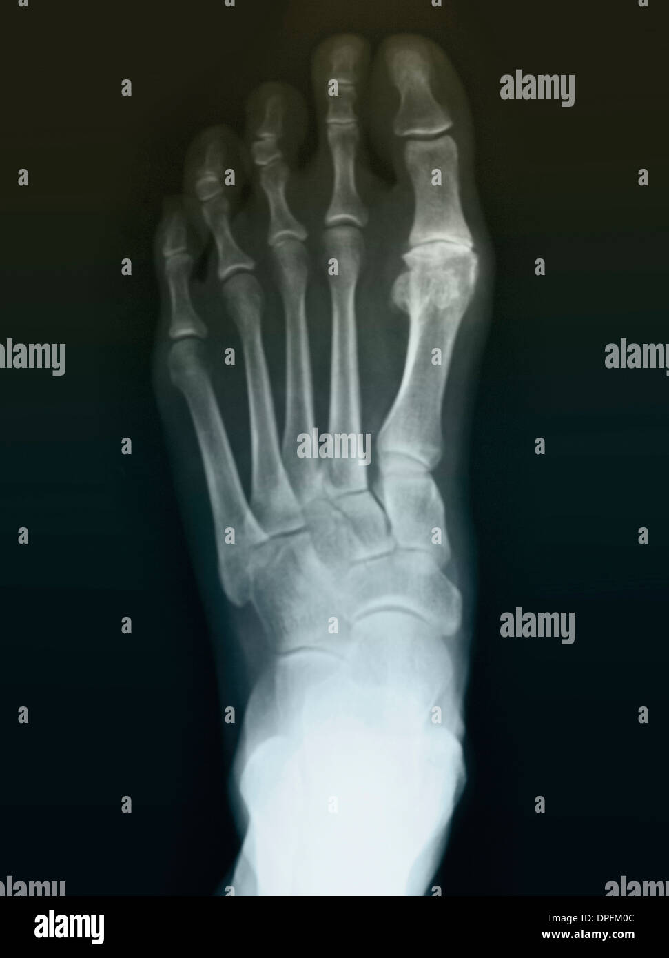 Piede normale x-ray di 59 anno vecchia donna Foto Stock