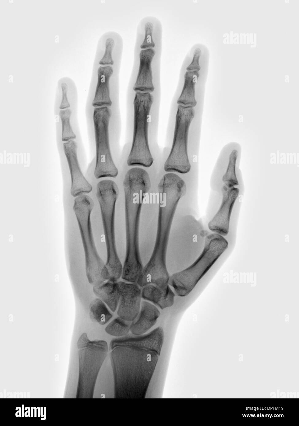 Mano normale x-ray di un ragazzo di 15 anni Foto Stock