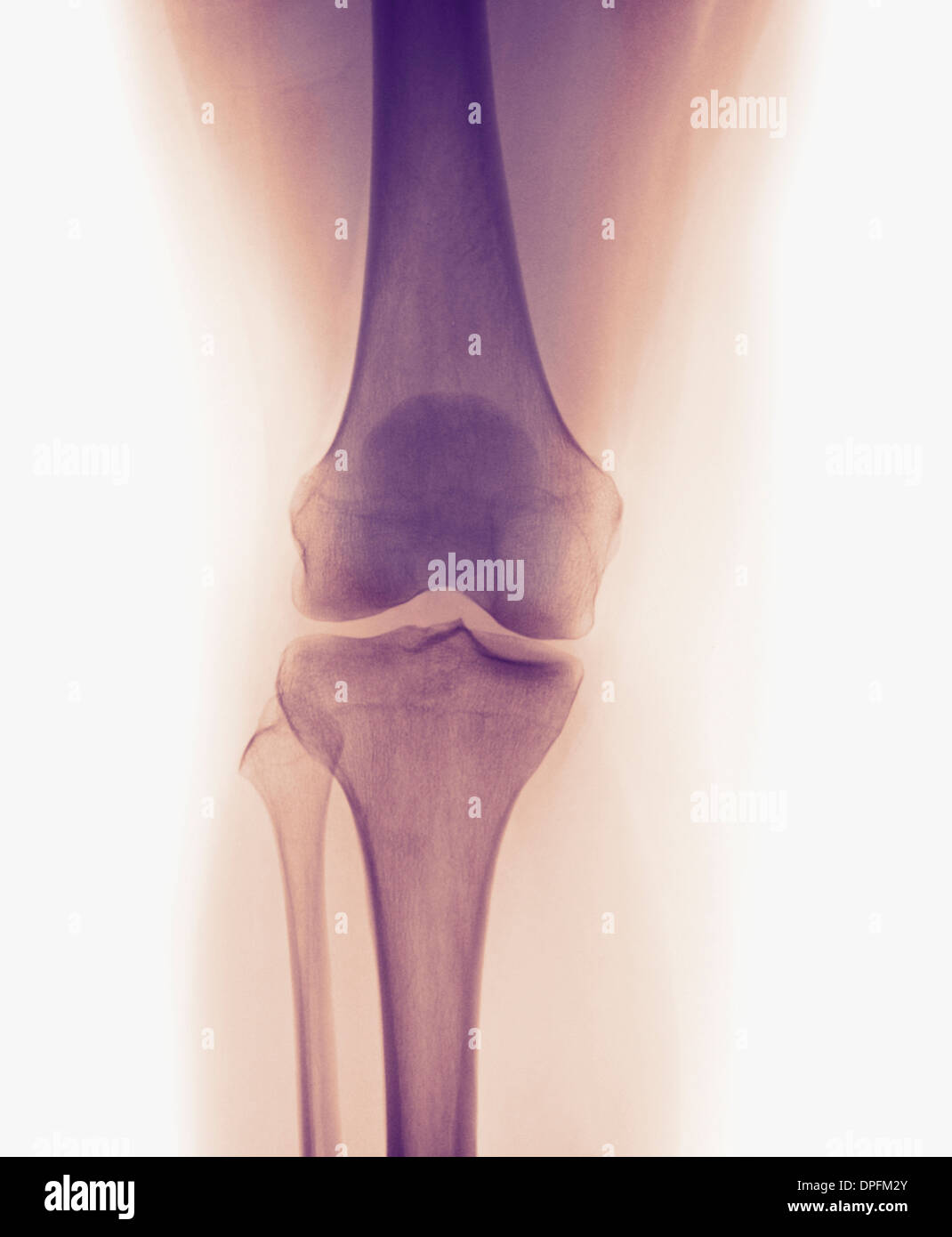Ginocchio normale x-ray di 33 anno vecchia donna Foto Stock