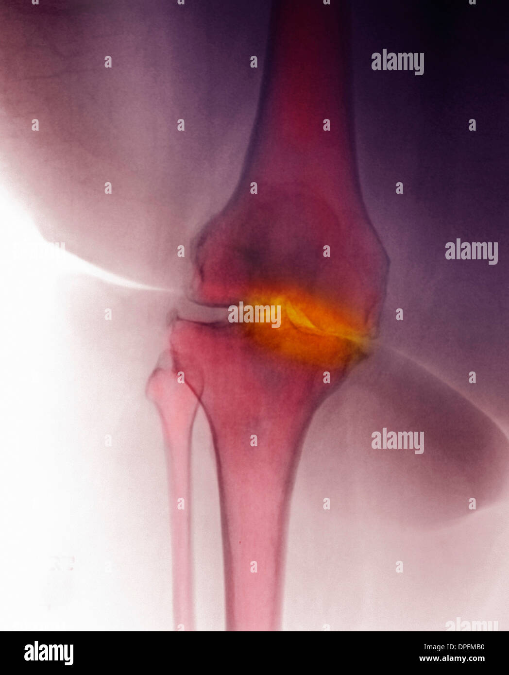 X-ray del ginocchio che mostra artrite degenerativa Foto Stock