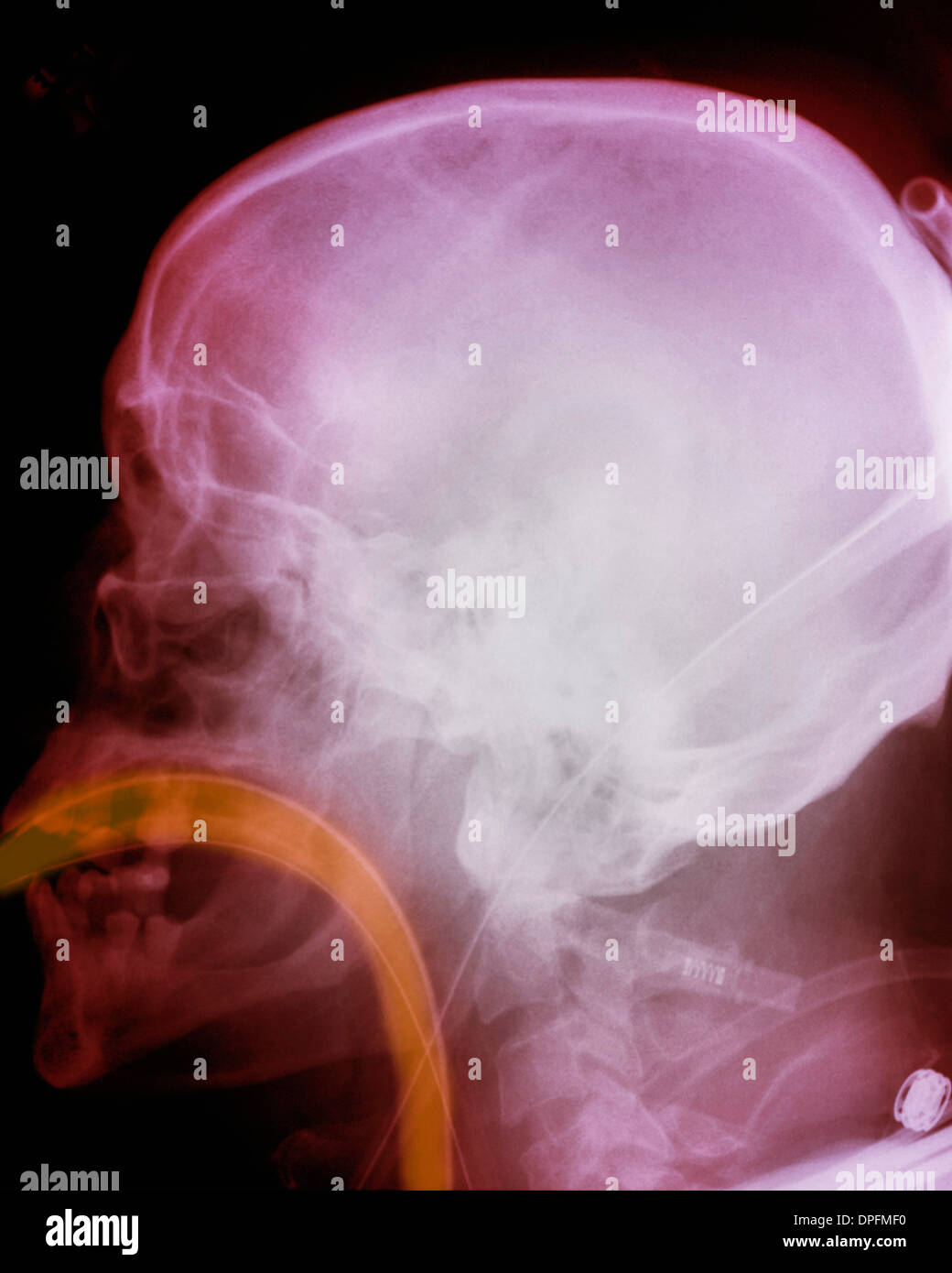 Raggi X del cranio che mostra l'intubazione Foto Stock