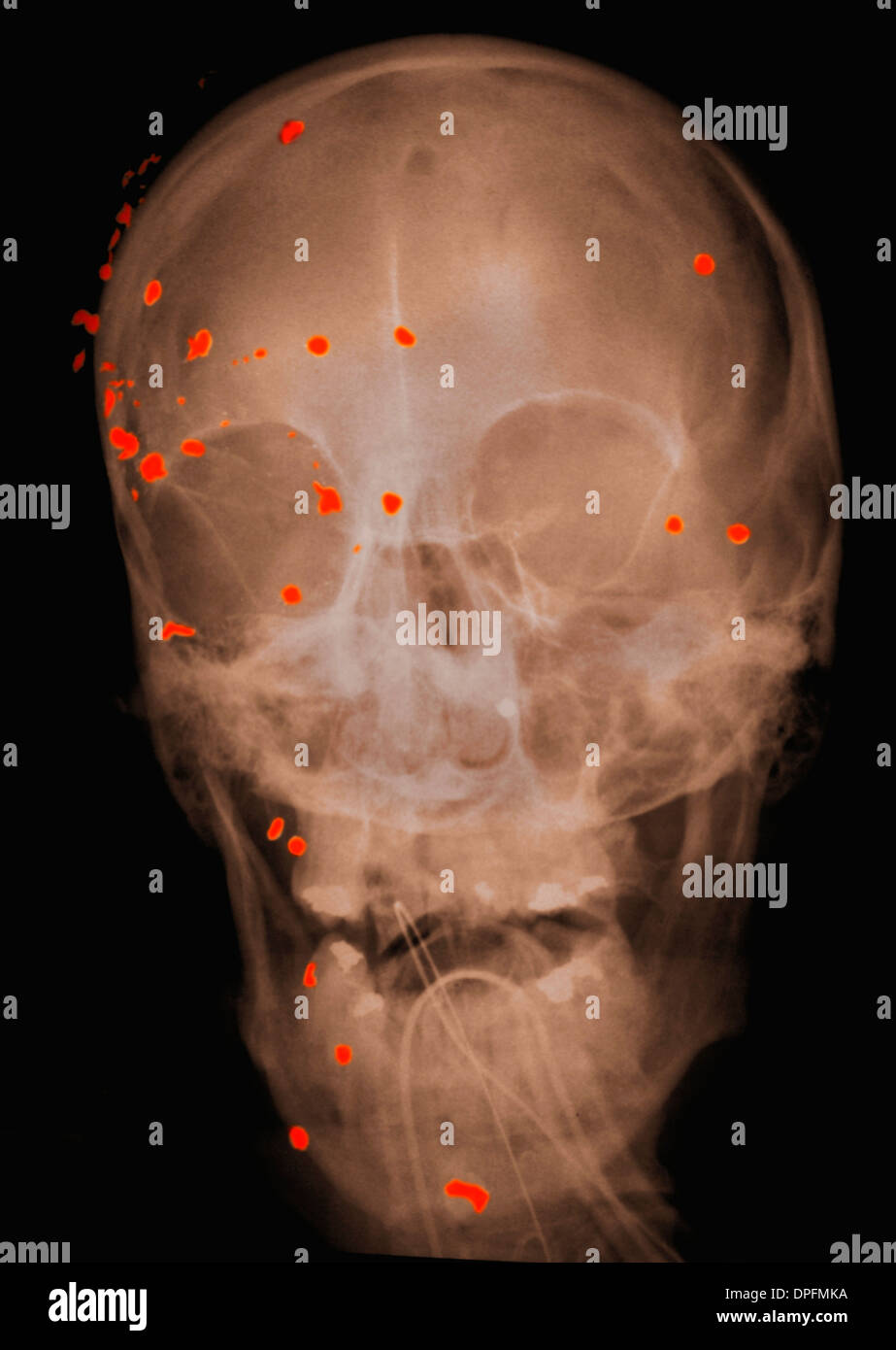 Raggi X del cranio che mostra ferite di armi da fuoco Foto Stock