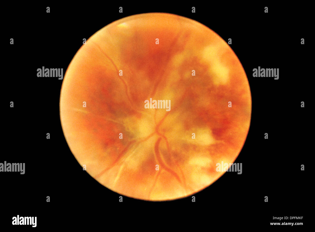 Retina del paziente di AIDS con chorioretinitis Foto Stock