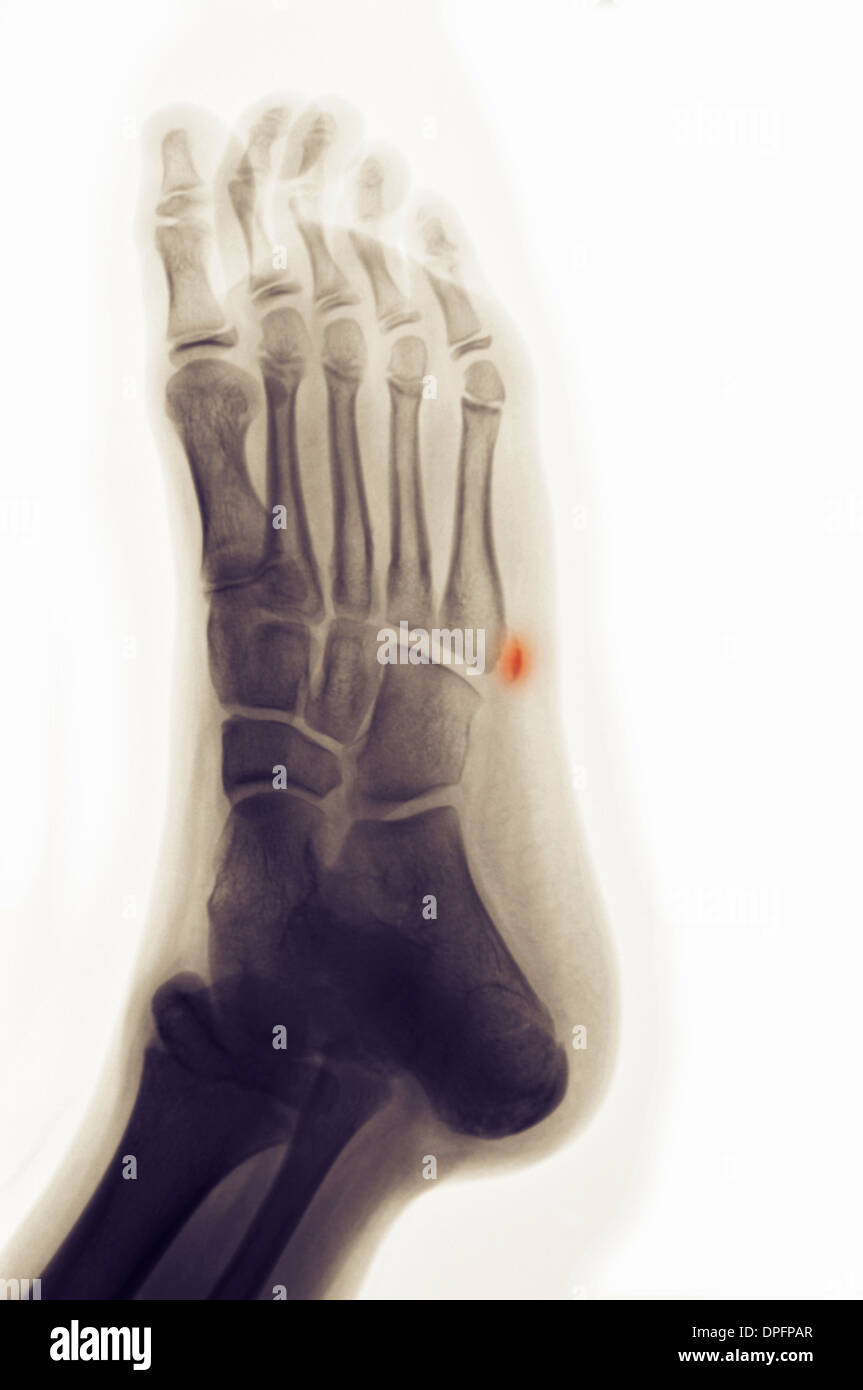 X-ray del piede che mostra avulsione frattura Foto Stock