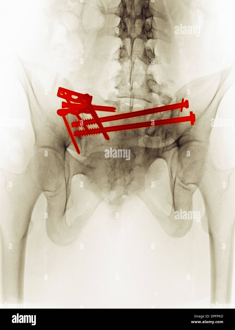 Raggi X che mostra la riparazione chirurgica della frattura pelvica Foto Stock