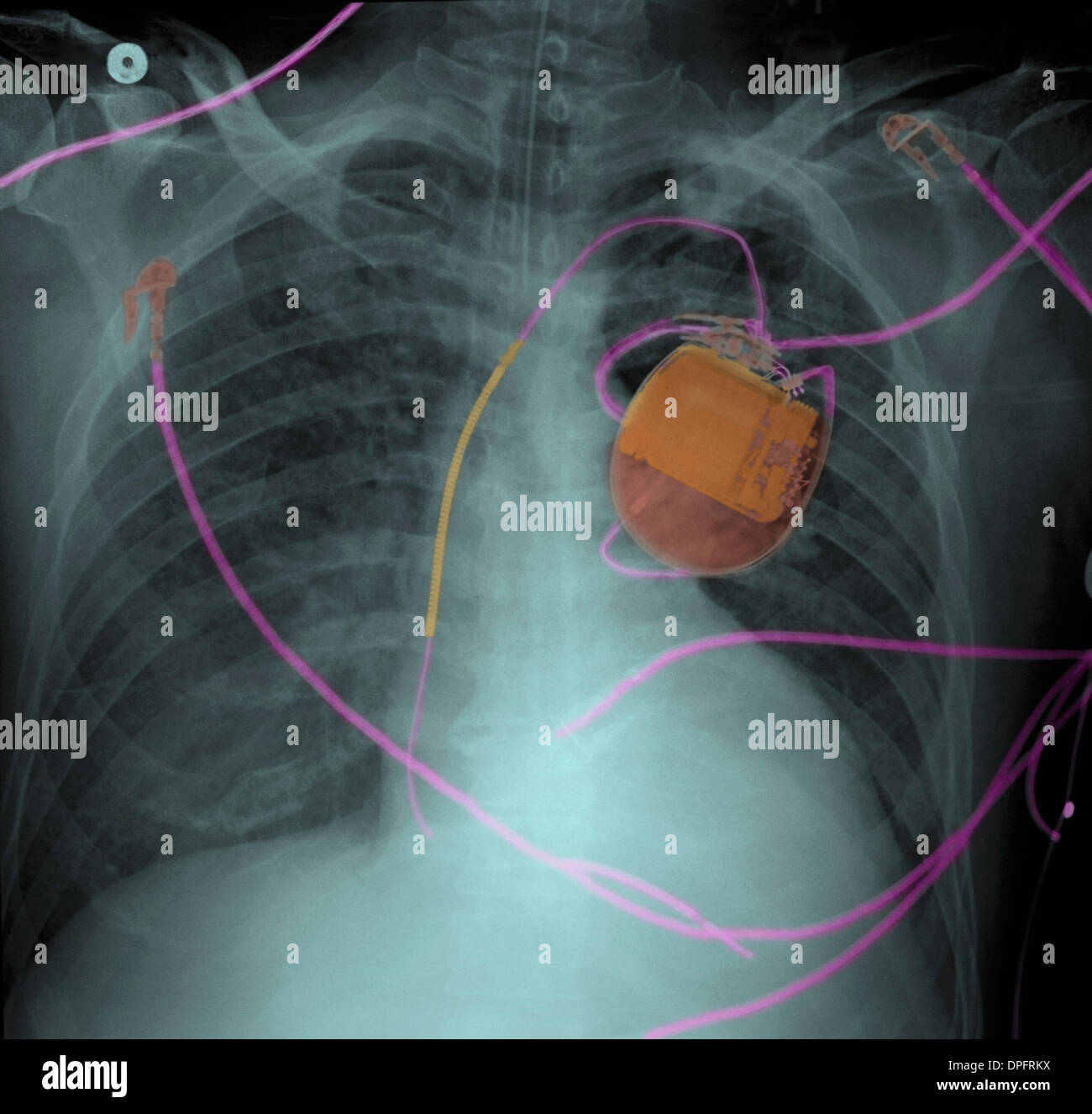 I raggi x al torace del pacemaker e di edema polmonare Foto Stock