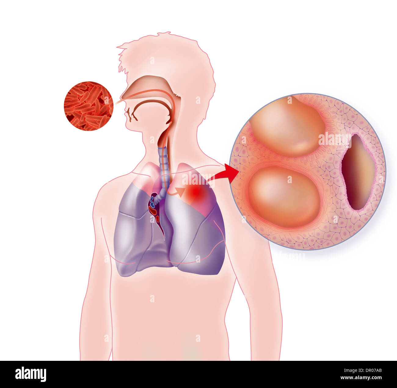 La tubercolosi polmonare, disegno Foto Stock