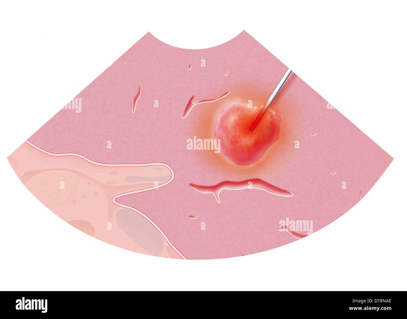 Ablazione a radiofrequenza Foto Stock