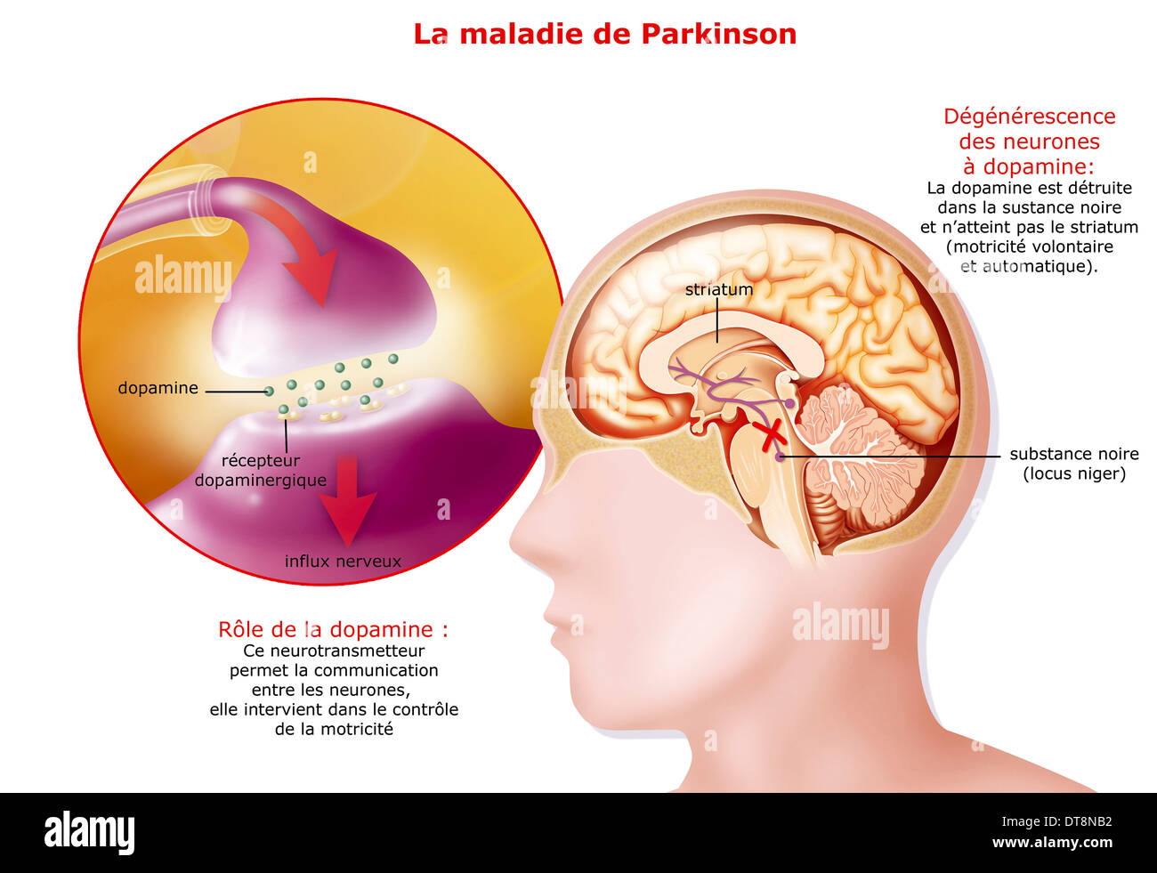 Il Morbo di Parkinson, disegno Foto Stock