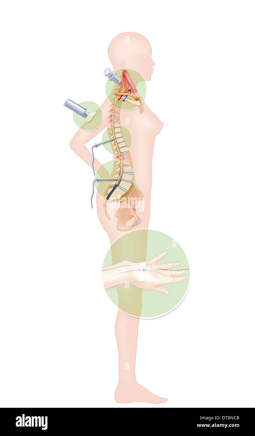 Disegno di anestesia Foto Stock