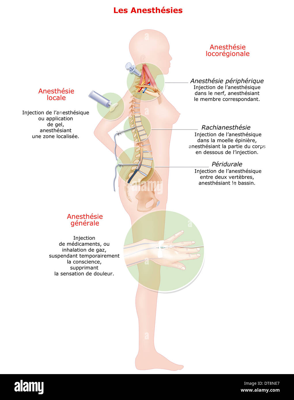 Disegno di anestesia Foto Stock