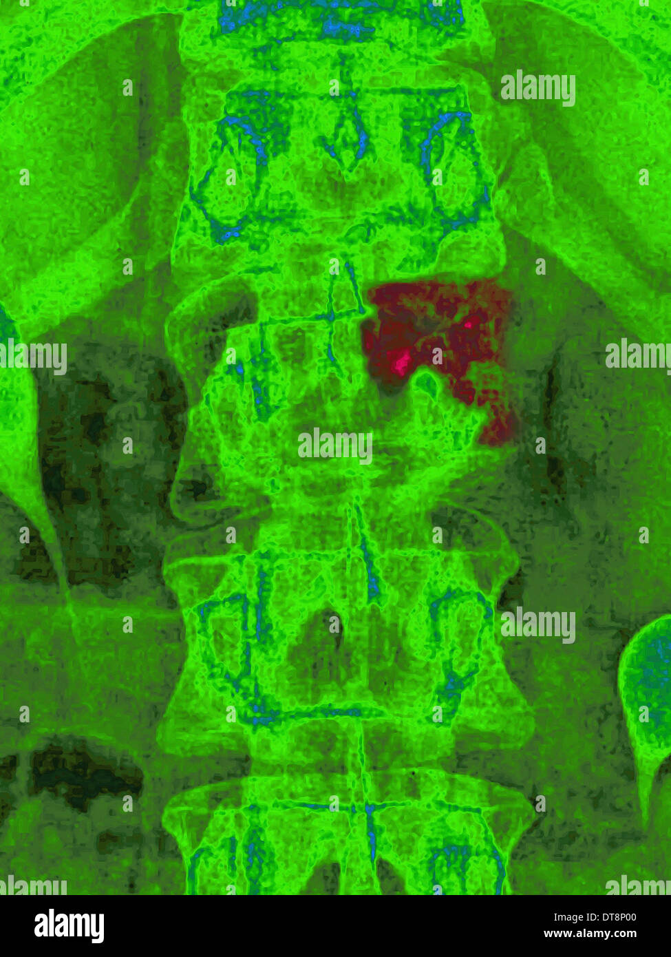 La metastasi, vertebre lombari Foto Stock