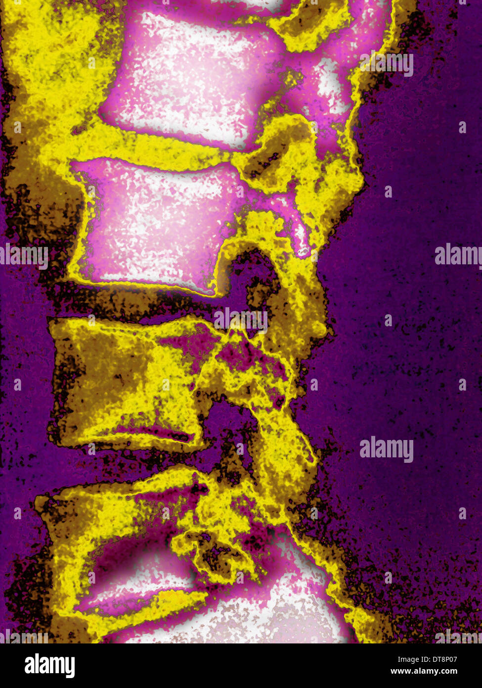 La metastasi, vertebre lombari Foto Stock