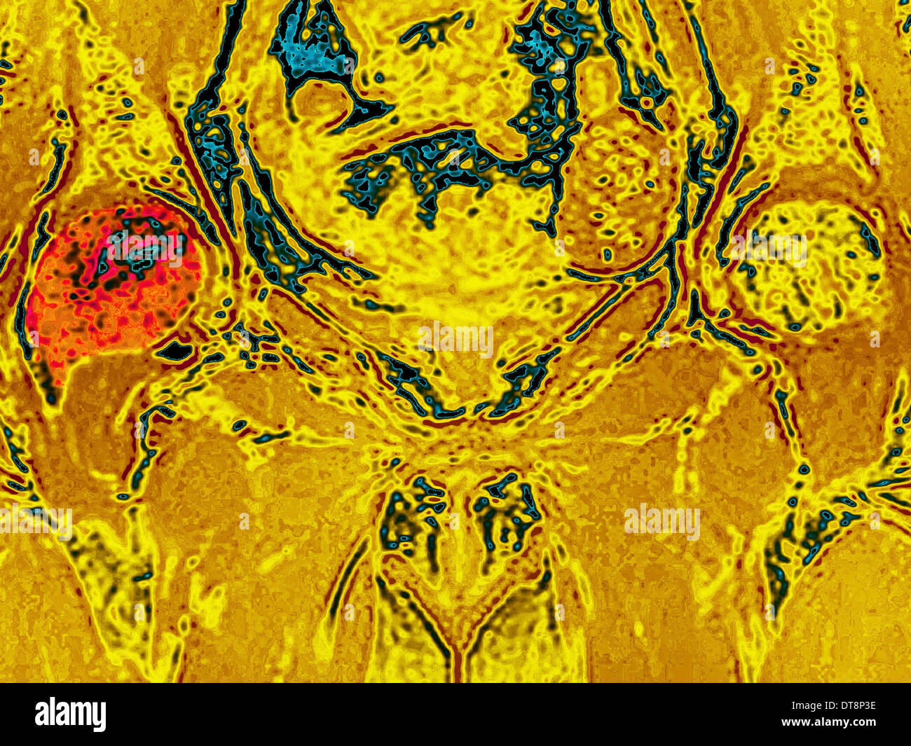 Metastasi ossee, MRI Foto Stock