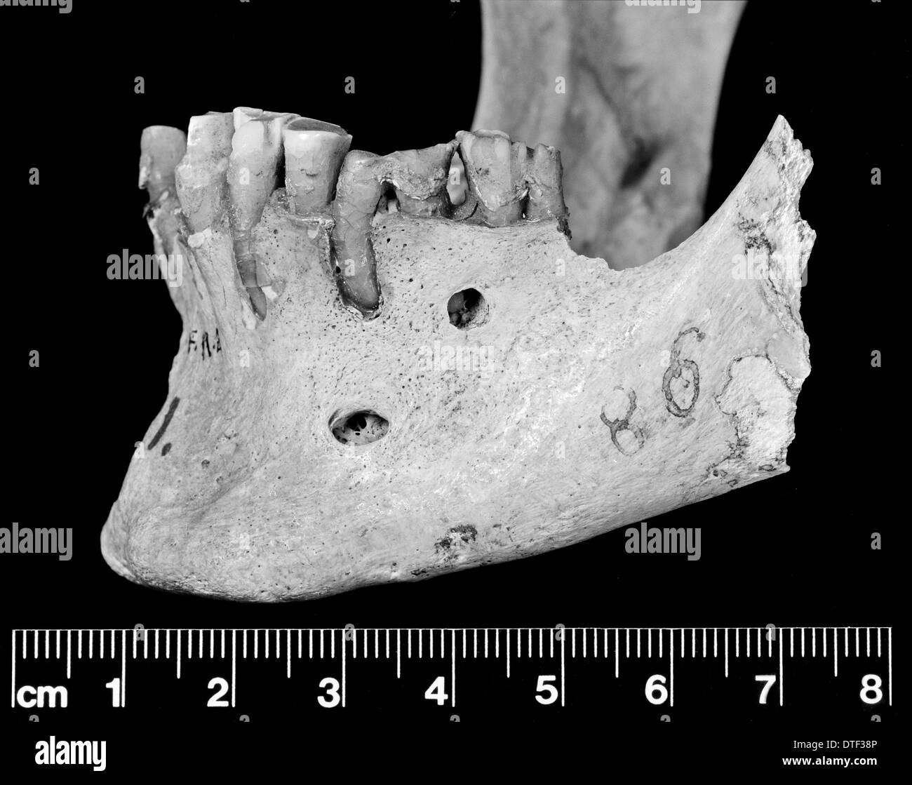 Vista laterale della mandibola Foto Stock