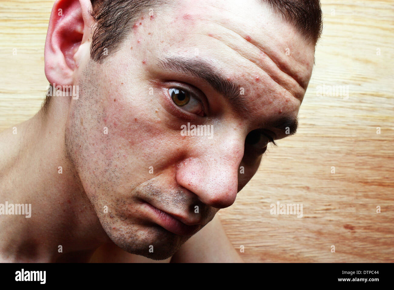 Acne brufoli sulla faccia di un giovane uomo Foto stock - Alamy