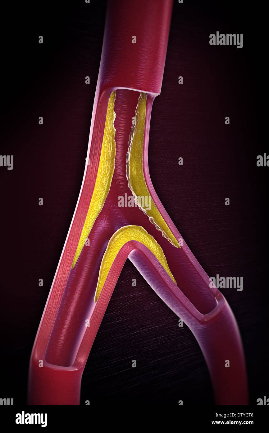 Aterosclerosi Foto Stock