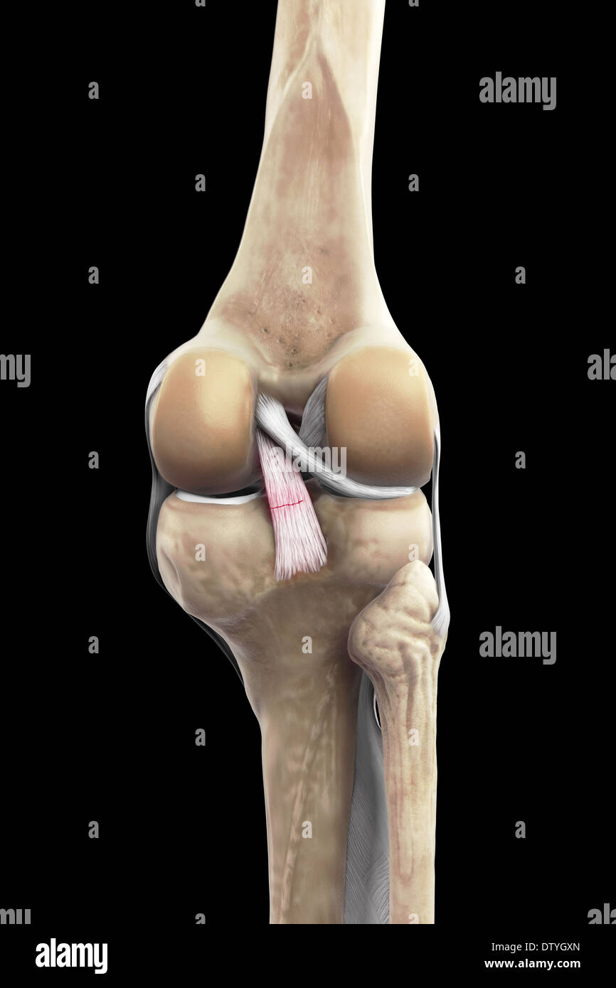 Legamento Crociato posteriore del pregiudizio Foto Stock