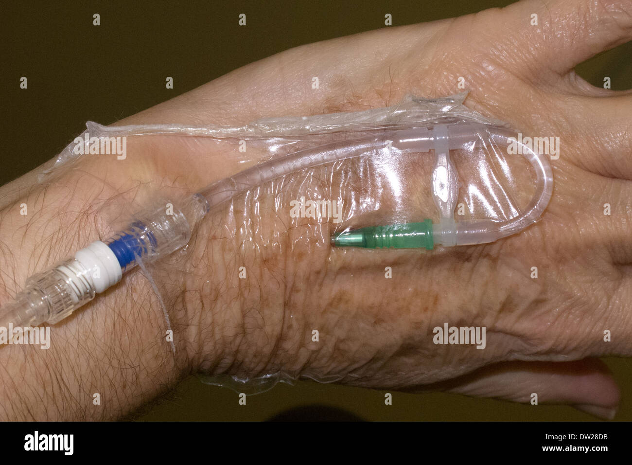 Sgocciolare in mano del paziente dopo la chirurgia Foto Stock