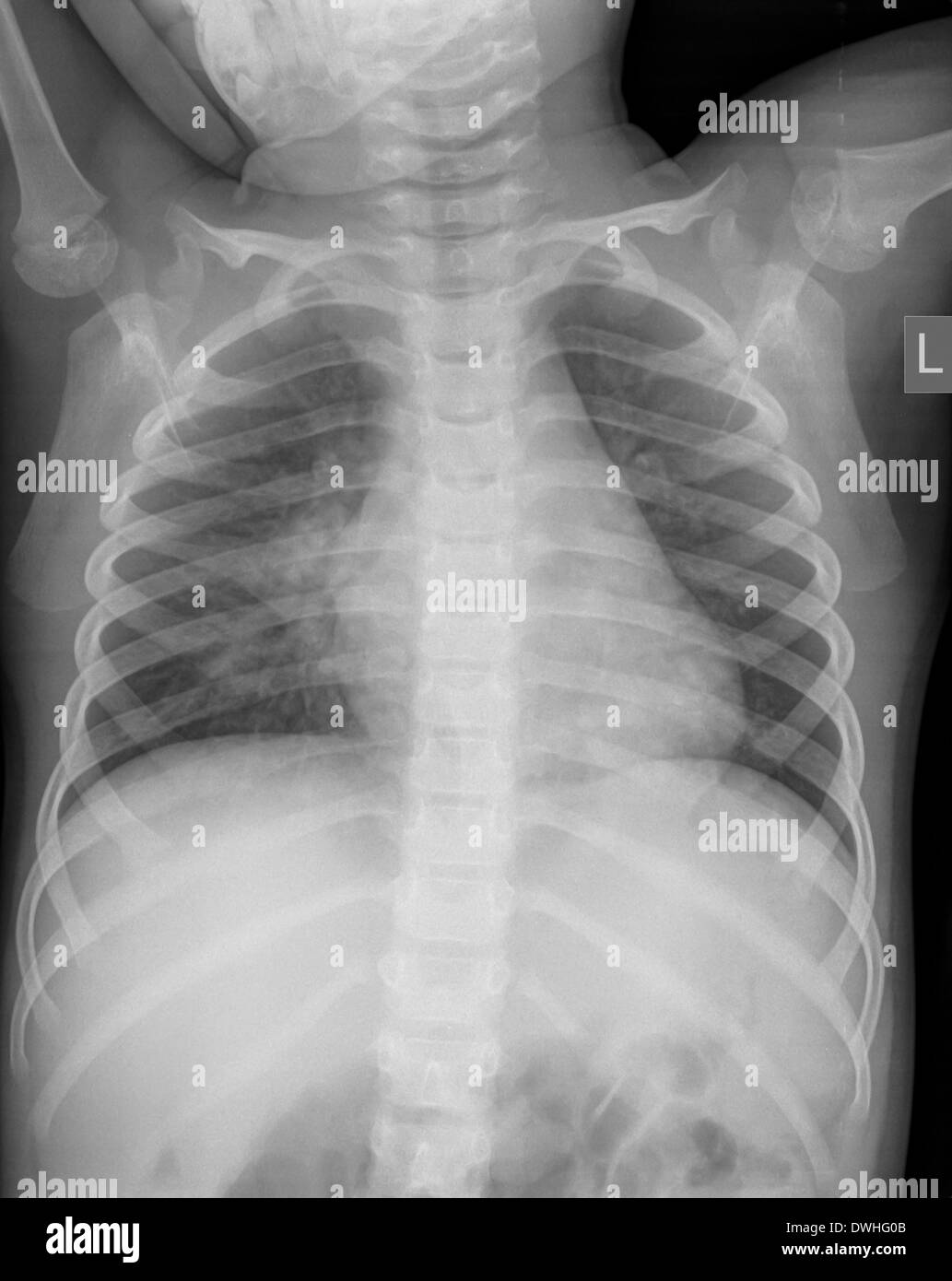I raggi x al torace di un 3 anno di età del paziente femmina con segni di polmonite in basso a sinistra il lobo (LLL) del suo polmone vista anteriore Foto Stock