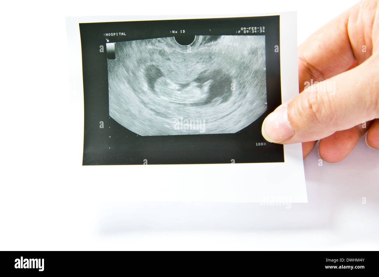 12 Settimane bambino immagine ad ultrasuoni Foto Stock