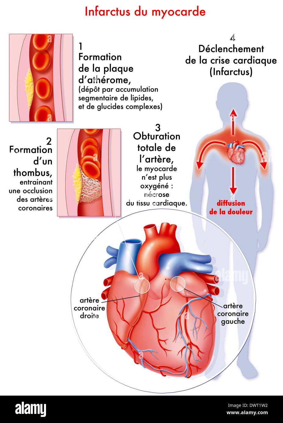 Attacco di cuore, disegno Foto Stock