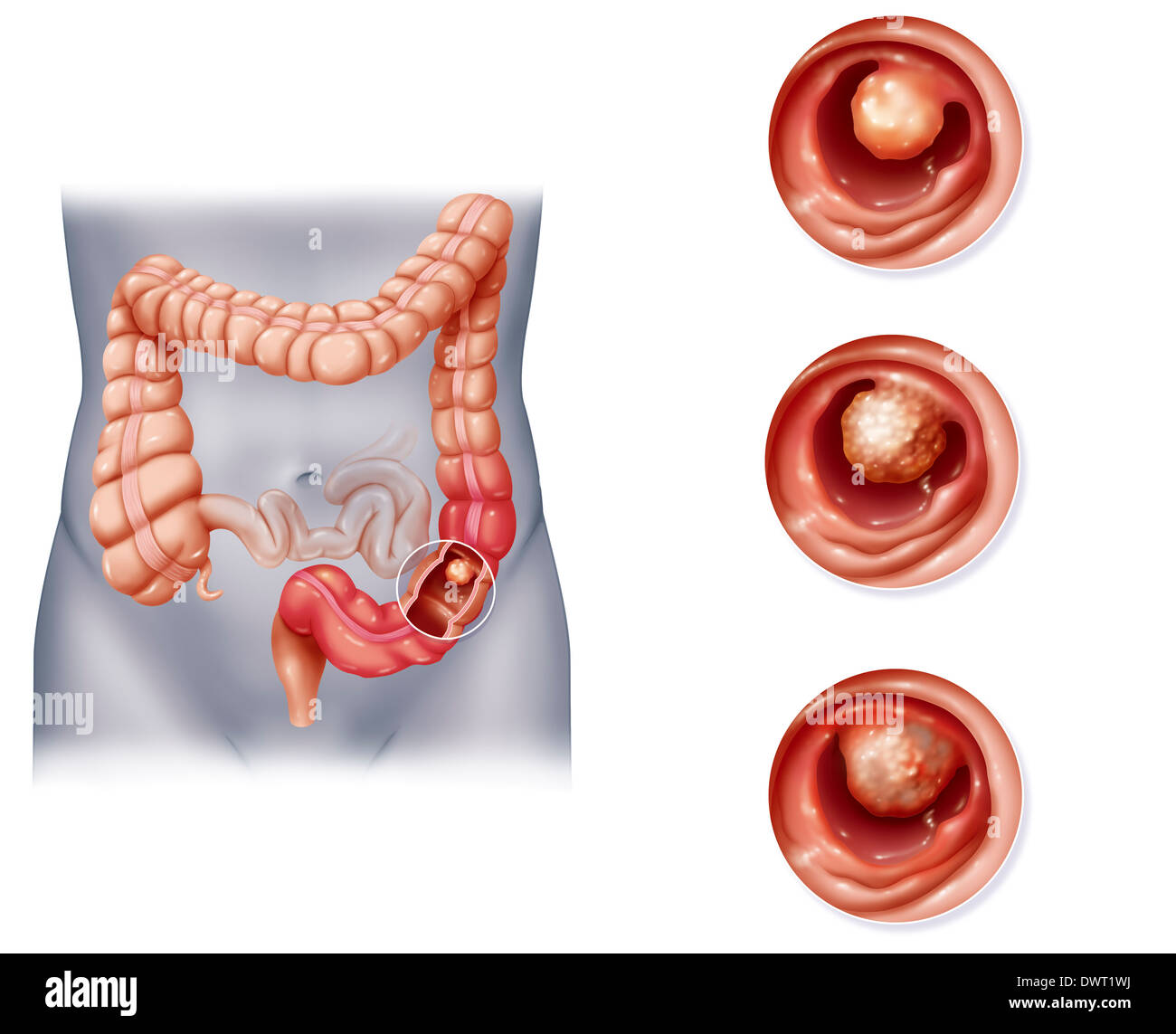 Il cancro del colon, disegno Foto Stock