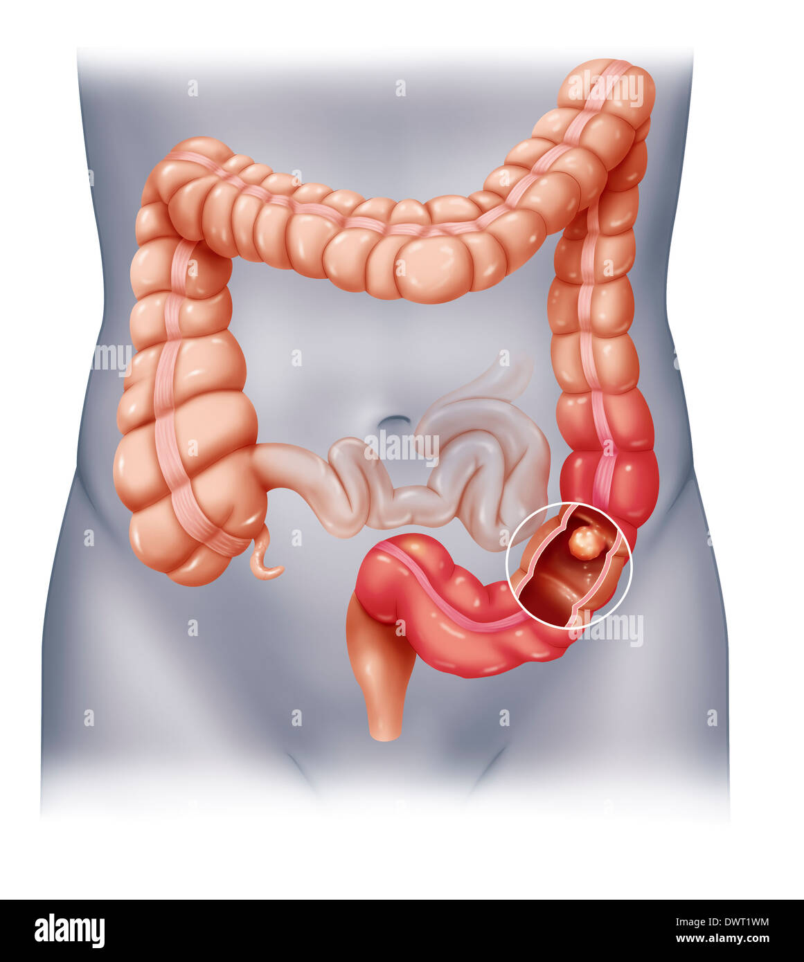 Il cancro del colon, disegno Foto Stock