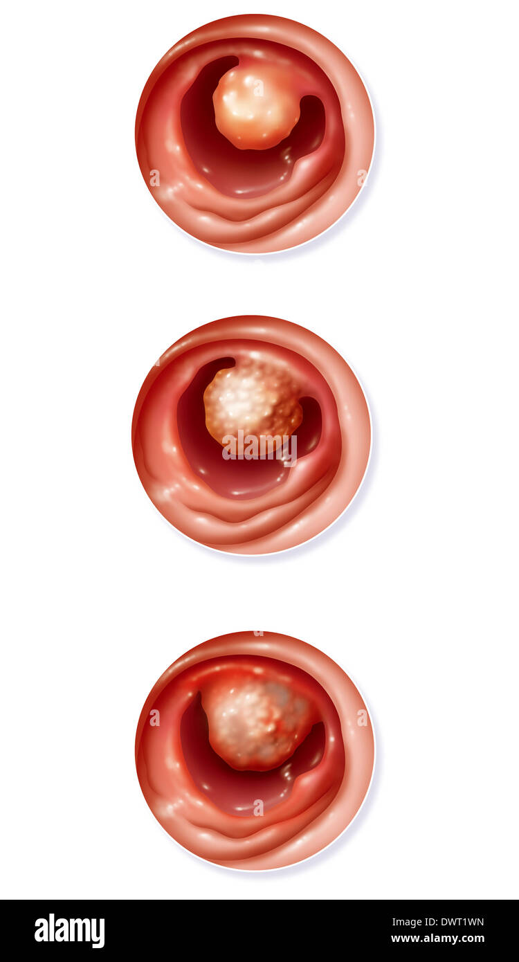 Il cancro del colon, disegno Foto Stock