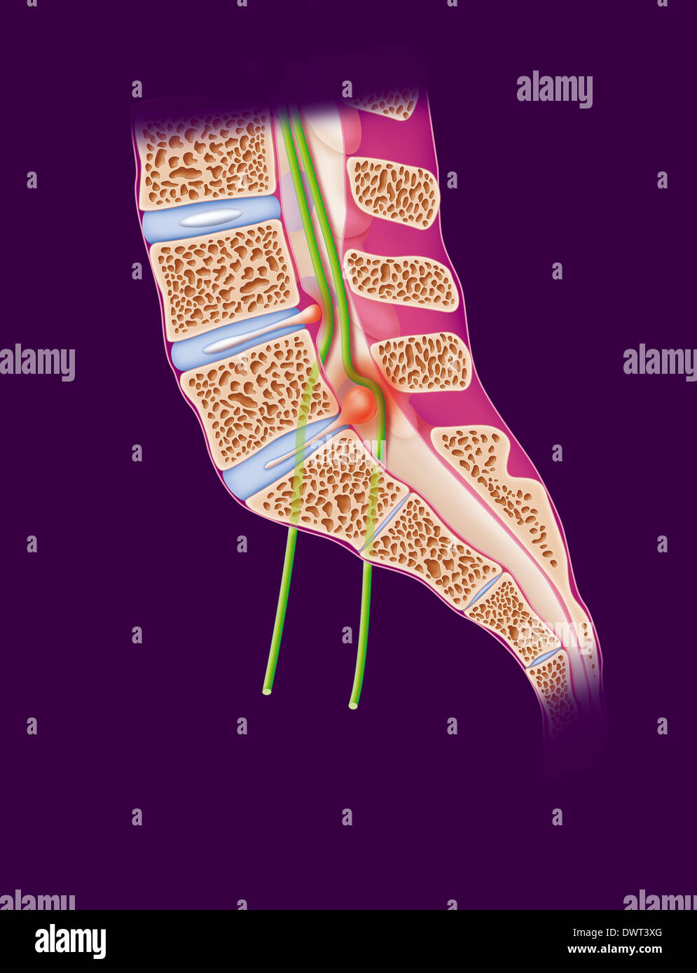Sciatica, disegno Foto Stock