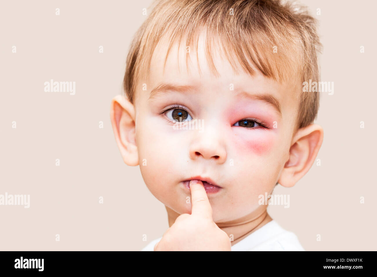 Little Boy - pericolose da punture di vespe vicino all'Occhio - immagine isolata Foto Stock