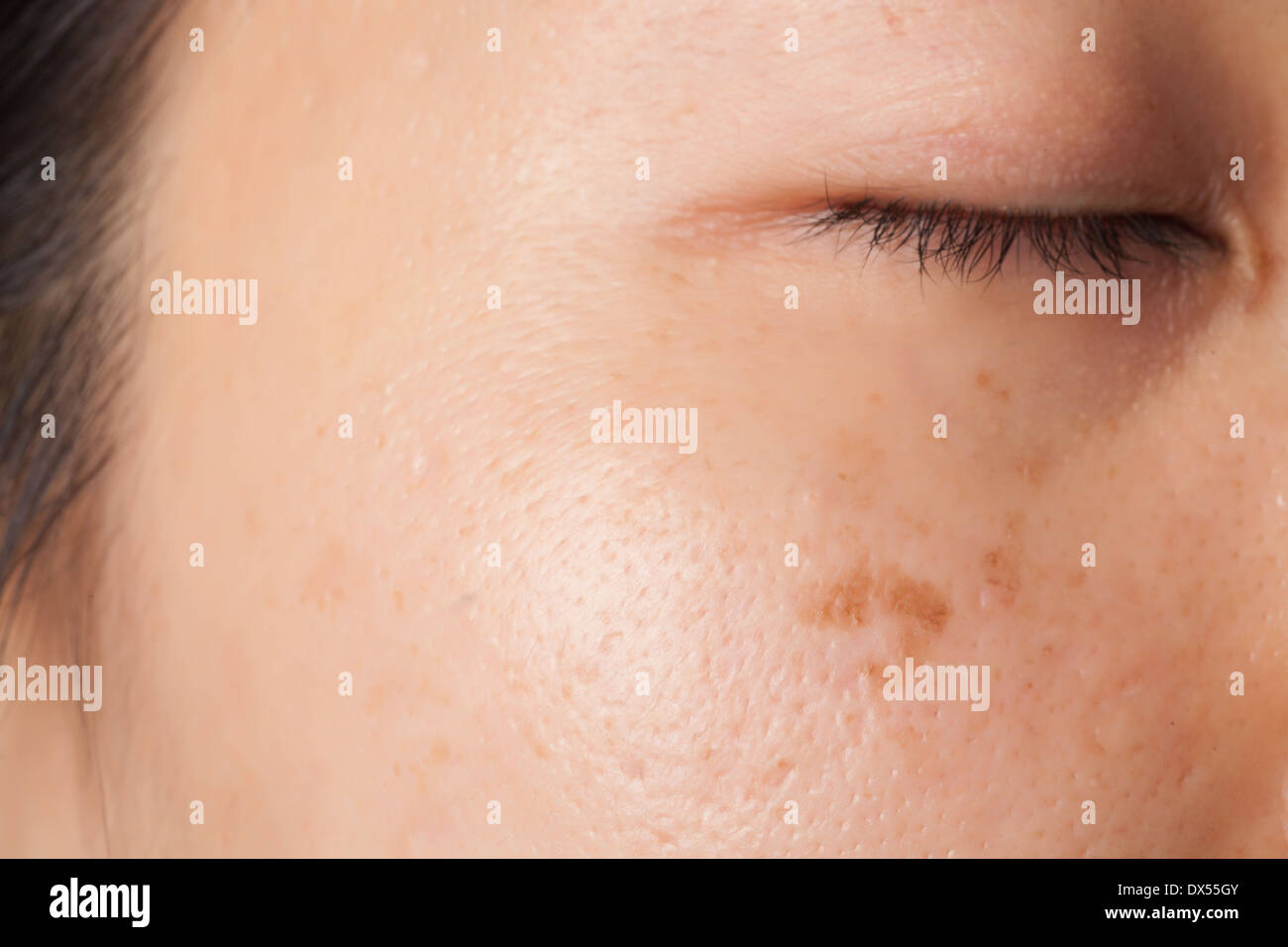 Le donne problema della pelle con imperfezioni e macchie Foto stock - Alamy
