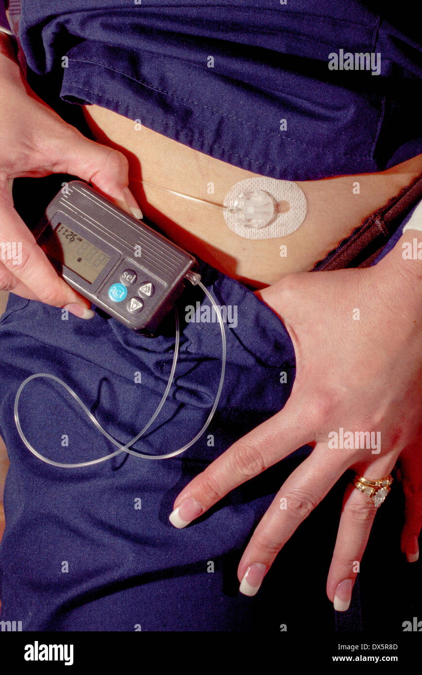 Un sistema elettronico di pompa di insulina è un dispositivo medico  utilizzato per la somministrazione di insulina nel trattamento del diabete  mellito, noto anche come infusione continua sottocutanea di insulina  terapia Foto