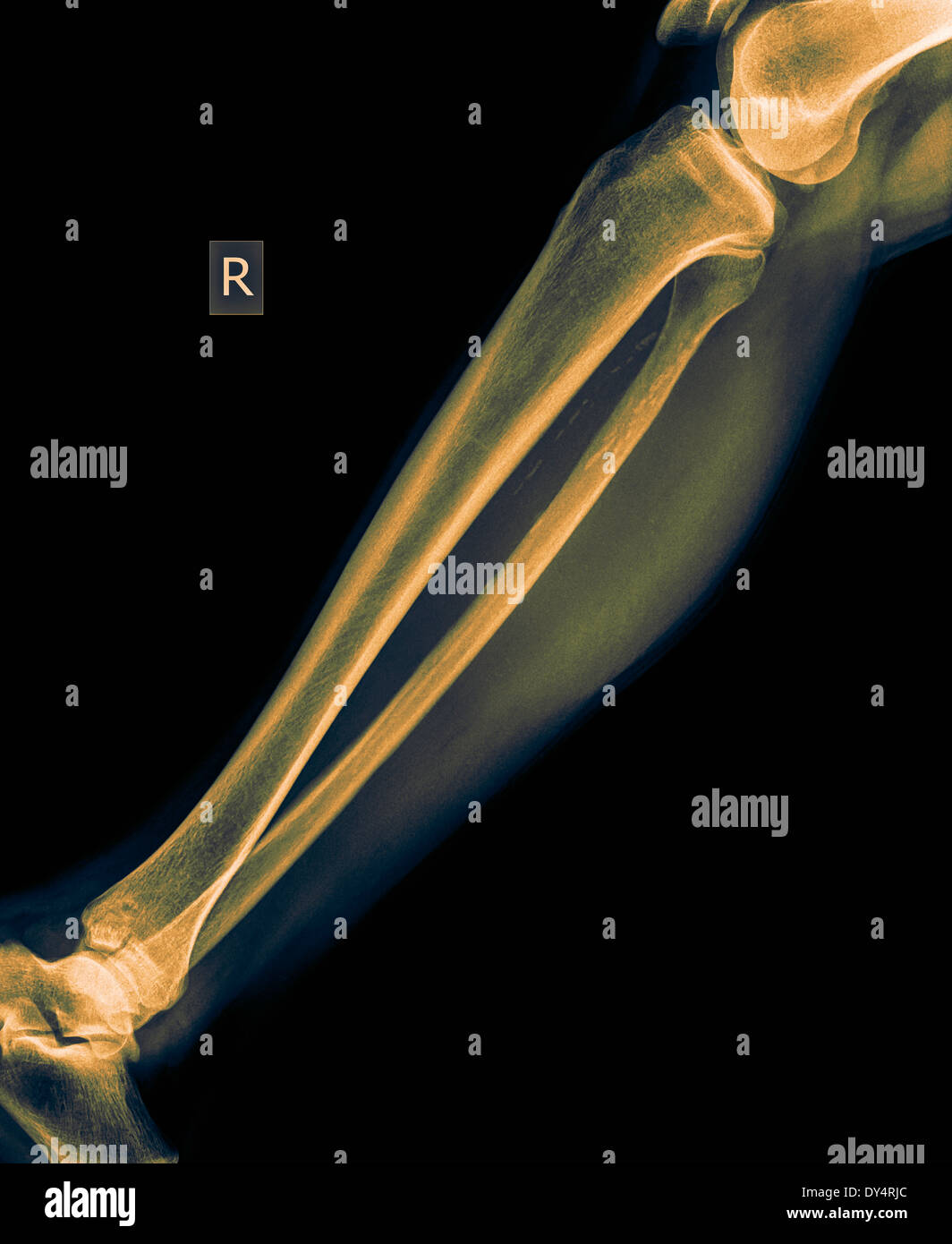X-ray di gamba inferiore del maschio di 50 anni con frattura della tibia vista anteriore Foto Stock