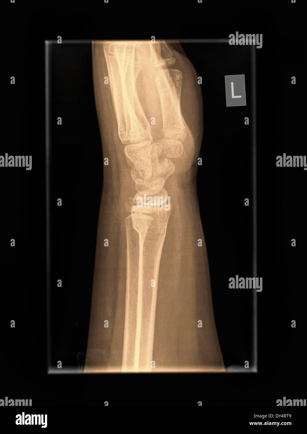 X-ray del polso di 9 anno vecchio paziente di sesso maschile con distale di radio e ulna fratture Foto Stock