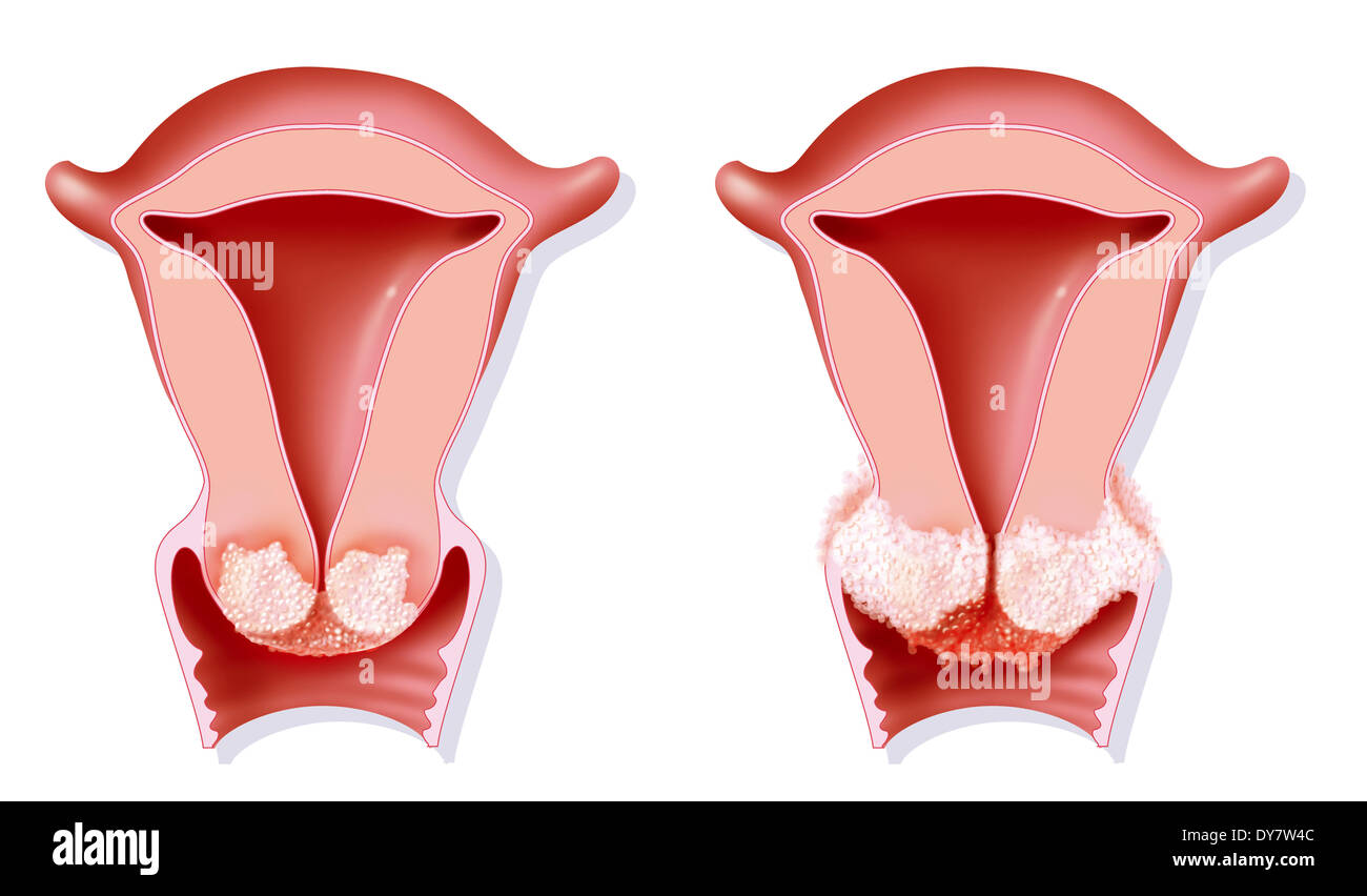Il cancro cervicale, disegno Foto Stock