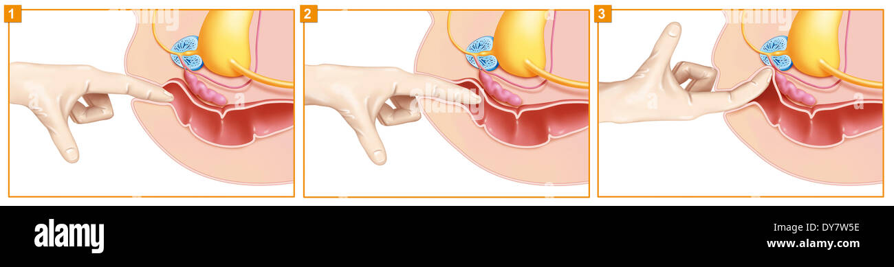 L'esame rettale digitale, disegno Foto Stock