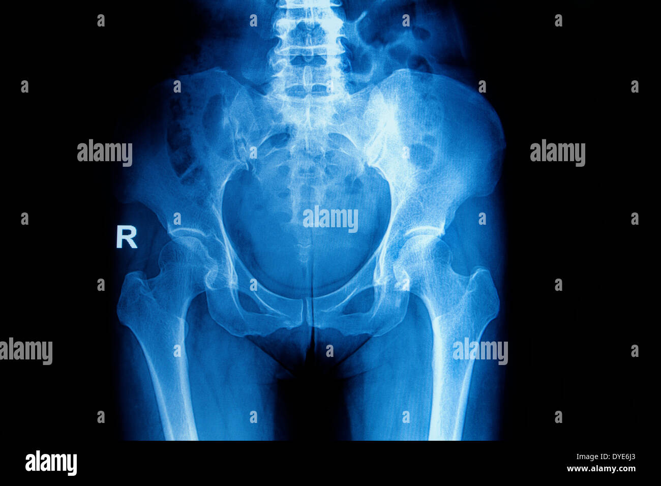 Immagine a raggi X del bacino e anca di una donna Foto Stock