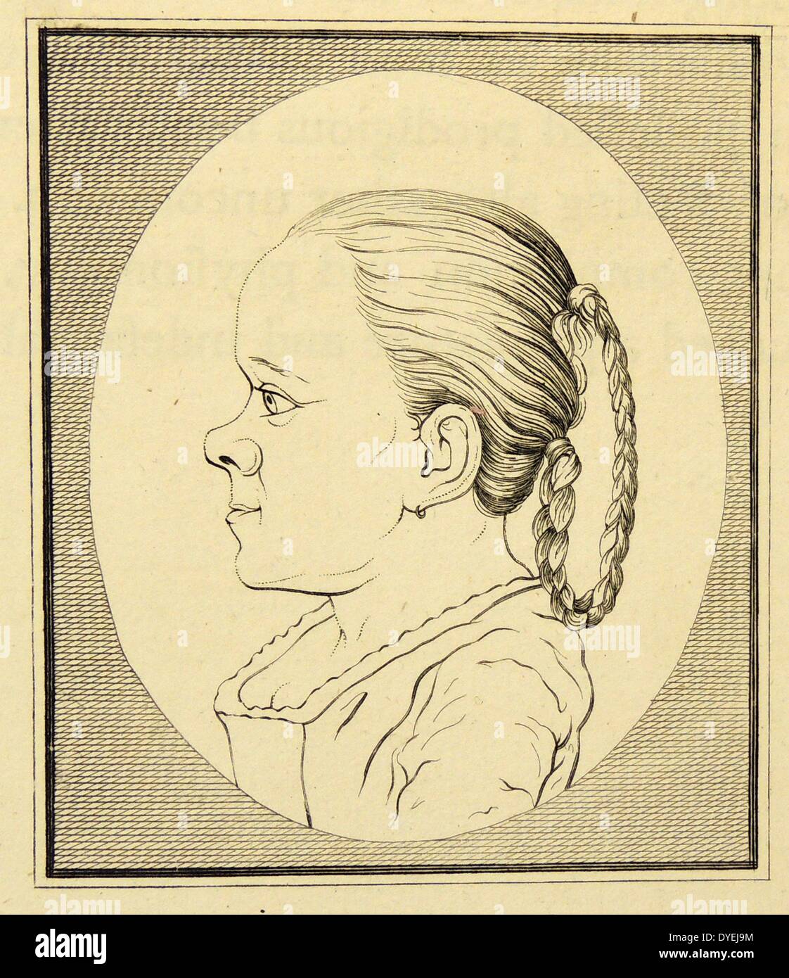 Achondroplasia, un disturbo ereditario dello scheletro trasmessa attraverso un gene dominante. Testa di una ragazza di 16, 2 m di altezza e con tipico fronte sporgente. Dal ''saggi nella fisionomia'', London, 1792, da J.K. Lavater. Foto Stock