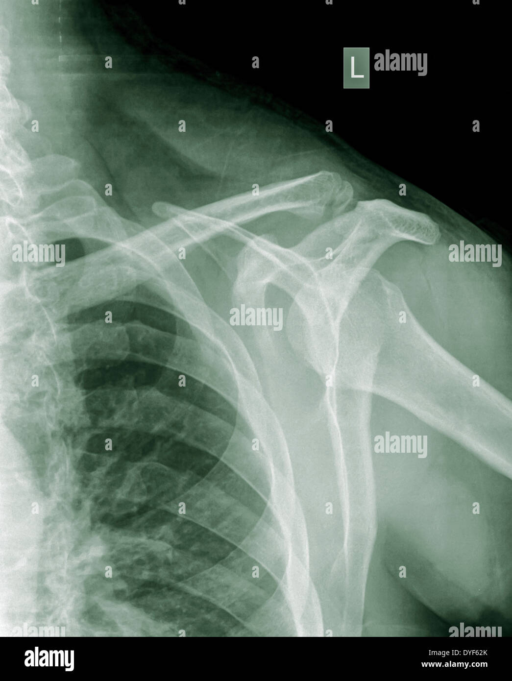Spalla x-ray di 40 anno vecchio paziente di sesso maschile con una clavicola fratturata vista frontale Foto Stock