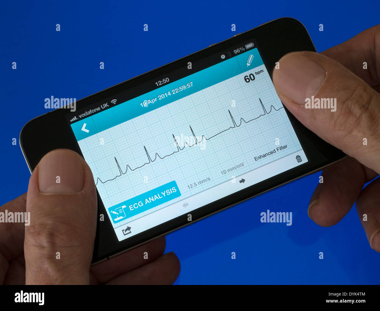 Utente azienda ECG portatile EKG Cardiofrequenzimetro App in esecuzione su iPhone 4 che mostra sinusale normale ritmo cardiaco con un battito ectopico Foto Stock