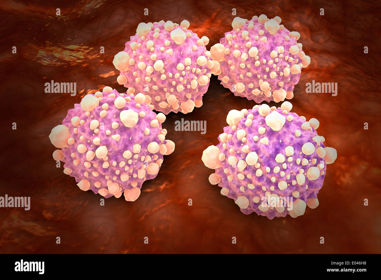 Vista Microscipic delle cellule del tumore pancreatico. Foto Stock