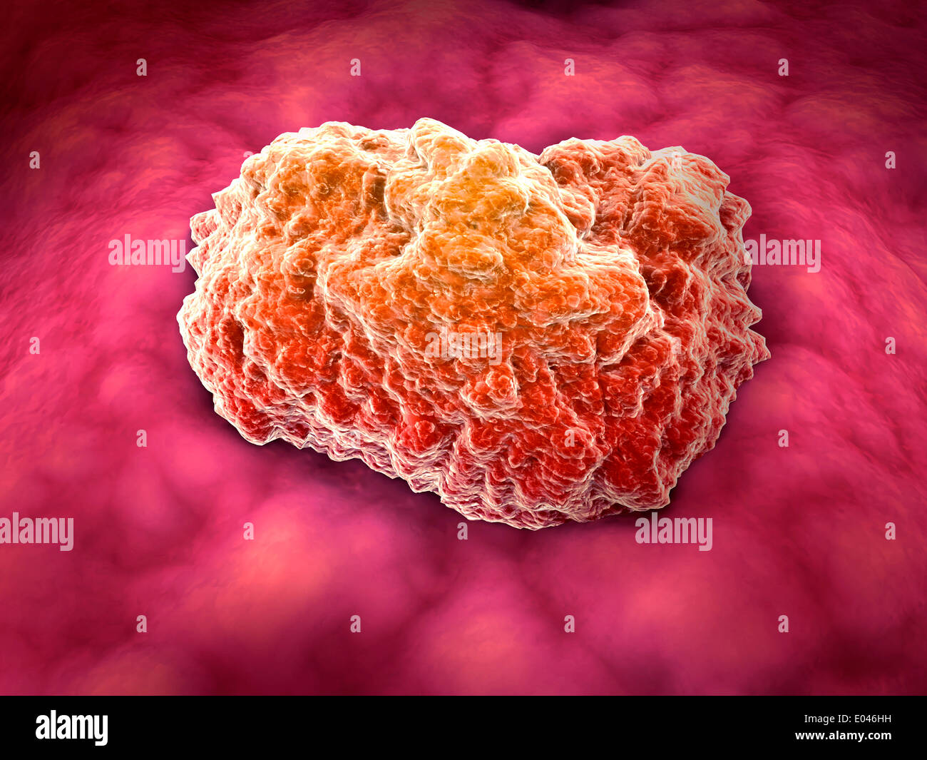 Vista microscopico di tumore. Foto Stock
