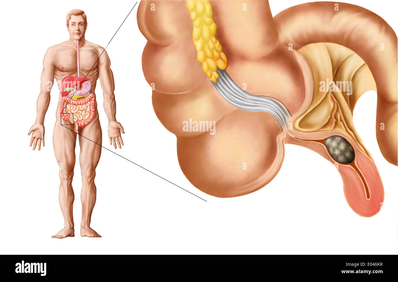 Medical illustrazione di un appendice con appendicite. Foto Stock