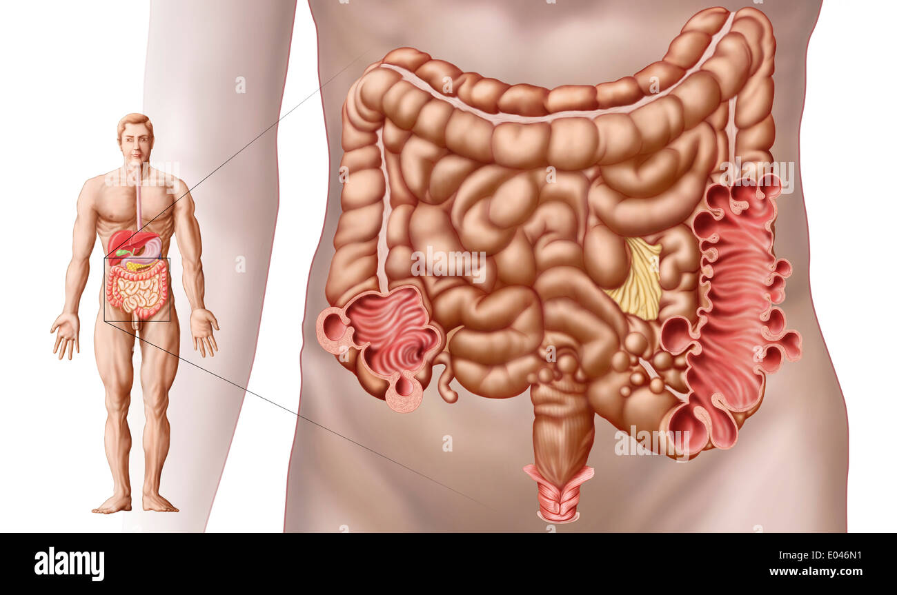 La diverticolosi del colon discendente regione dell'intestino umano. Foto Stock