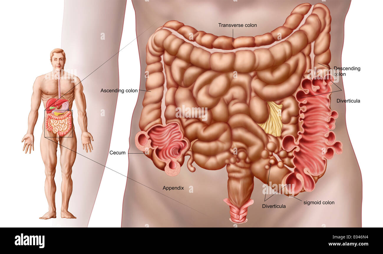La diverticolosi del colon discendente regione dell'intestino umano Foto Stock