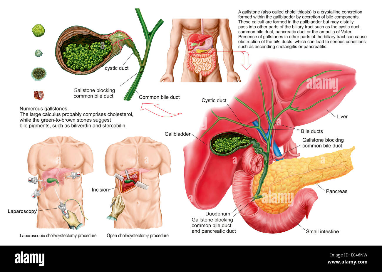 Medical illustrazione che mostra i calcoli biliari nella cistifellea e la rimozione chirurgica della cistifellea, noto come la colecistectomia. Foto Stock