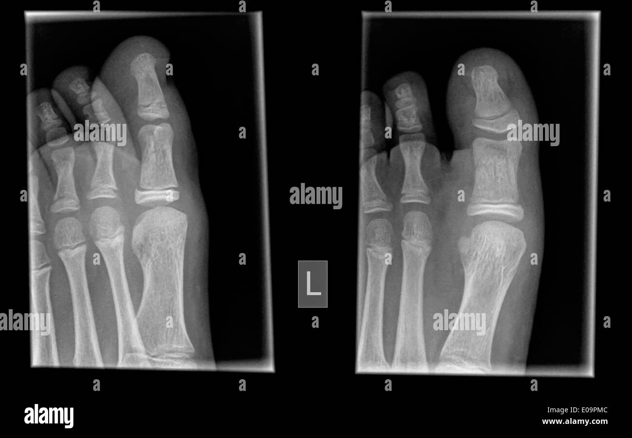 X-ray delle dita di un figlio di dieci anni di un paziente con un mid falange frattura Foto Stock