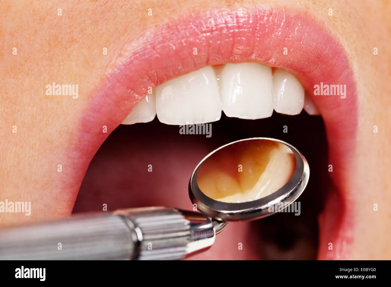 Denti di una giovane donna sono esaminati con il dentista di dentista in pratica, Zaehne einer jungen Frau werden beim Zahnarzt a Foto Stock