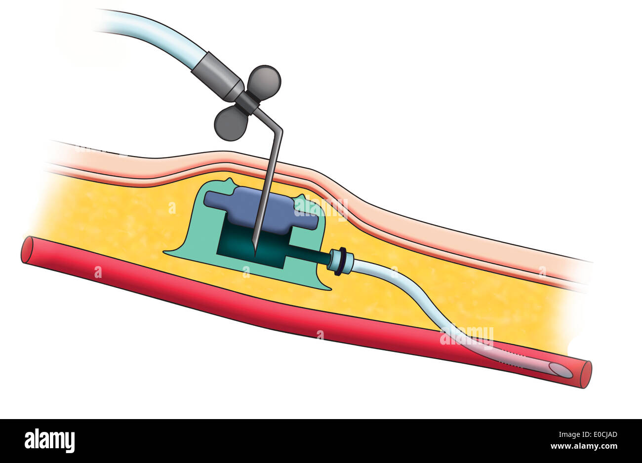 Accesso venoso centrale immagini e fotografie stock ad alta risoluzione